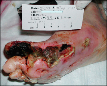 diabetic foot sores