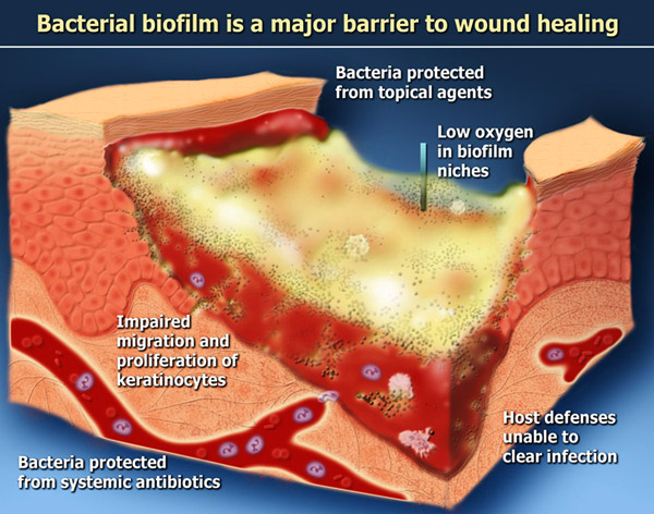 wound inflammation