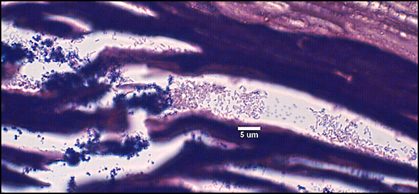 tissue section from a diabetic foot ulcer showing the presence of both Gram-positive cocci and Gram-negative rods